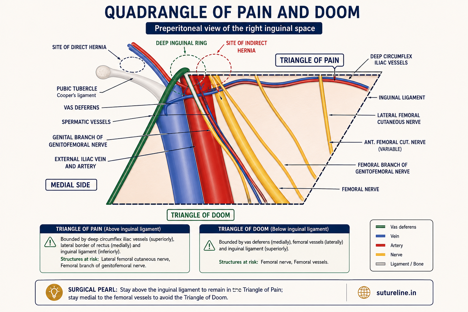 Quadrangle of pain and doom — preperitoneal view